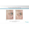 fractional skin resurfacing example 2, your results may vary