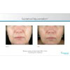 sublative rejuvenation, your results may vary