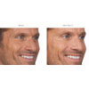 Botulinum Toxin (Botox/Xeomin) crow's feet example 2, your results may vary