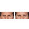 Botulinum Toxin (Botox/Xeomin) frown lines example 2, your results may vary