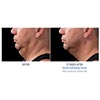 double chin 12 weeks male, your results may vary