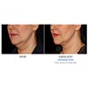 double chin 8 weeks female, your results may vary