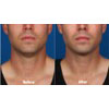 3a: male, age 34, before weight = 170 lbs, after weight = 179.5 lbs, your results may vary