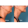 4b: female, age 55, before weight = 150.3 lbs, after weight = 150.3 lbs, your results may vary