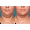 5a: female, age 39, before weight = 209.8 lbs, after weight = 214.6 lbs, your results may vary