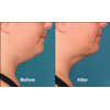 5b: female, age 39, before weight = 209.8 lbs, after weight = 214.6 lbs, your results may vary