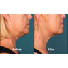 7b: female, age 54, before weight = 148.6 lbs, after weight = 147.6 lbs, your results may vary