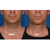 8a: male, age 47, before weight = 178 lbs, after weight = 179.5 lbs, your results may vary