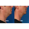 8b: male, age 47, before weight = 178 lbs, after weight = 179.5 lbs, your results may vary