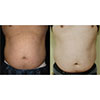 male, before (left): BMI 29.7 and waist 44 inches, after 16 treatments (right): BMI 29.4 and waist 28 inches, your results may vary