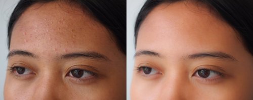before and after acne treatment on face.