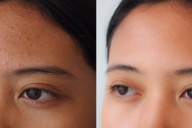 before and after acne treatment on face.