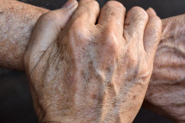 hands and arms with age spots.