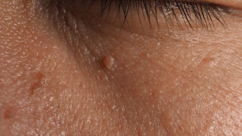 skin tag below eye.