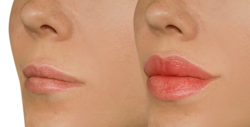 before and after lips treatment.