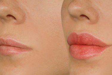 before and after lips treatment.