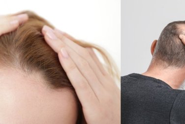 woman with receding hairline, man with bald spot.