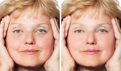 before and after wrinkle-reduction treatment.