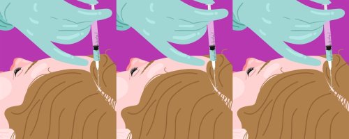 女性在髮際線接受PRF注射。