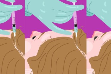 phụ nữ nhận tiêm PRF ở đường chân tóc.