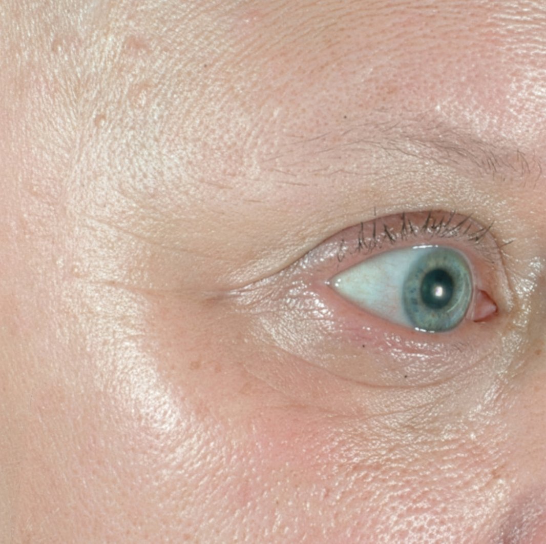 After 3 treatments