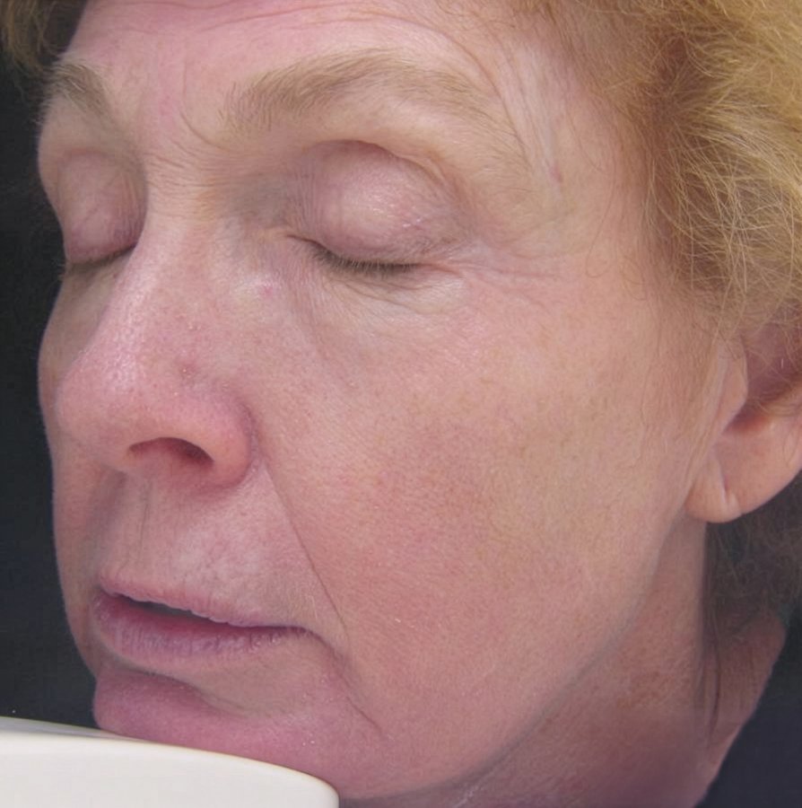 After 3 treatments