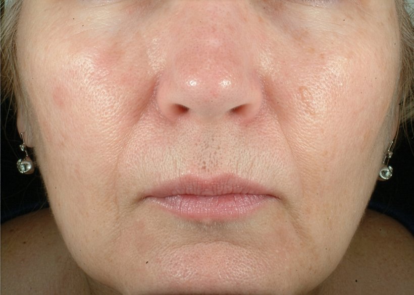 After 1 treatment