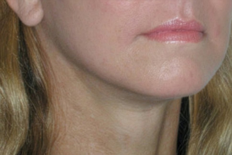 Después de 1 tratamiento