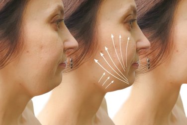 antes y después del procedimiento de lifting con hilos.