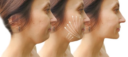 antes y después del procedimiento de lifting con hilos.